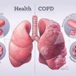 copd